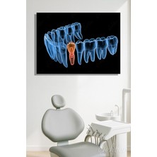 Şehber Diş Implantı (Yapay Diş Kökü) Tıbbi ve Anatomik 3 Boyutlu Illüstrasyon Yatay Kanvas Tablo Tekli 3659