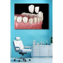 Şehber Diş Kaplama (Veneer) Uygulaması Sürecinin 3 D Aşamaları Tıbbi Illüstrasyon Yatay Kanvas Tekli Tablo 3671