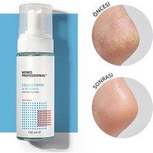 Momo Professional Callus Köpük, Nasır Sökücü Keratolitik Pedikür Köpük, 150 ml