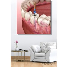 Şehzat Kare Kanvas Duvar Tablosu Ağız Diş Sağlığı Dişçi Kanal Tedavisi Endodonti Pulpa Kök Diş Çürüğü 3D