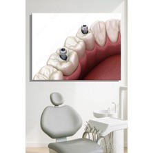 Şehber Dental Implant Sistemi Sabitleme Vidalarını Gösteren 3D Tıbbi Illüstrasyon Yatay Kanvas Tablo 4442
