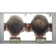 Mythriva Keratin Içeren Siyah Saç Fiberi Toz 50 Gr, 3 Adet