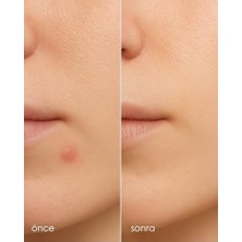 Stopever Clearly Spot Patch, Sivilce Karşıtı Şeffaf Plaster 2'li Paket | Ultra Ince, Hidrokolloid + Niacinamide + Salicylic Asit Içerikli Akne Karşıtı