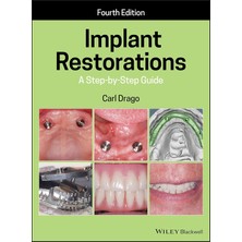 Str Store Implant Restorations: A Step–by–step Guide