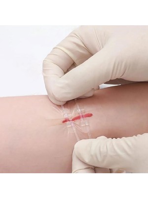 Longmed Acil yarık Kapatma, Fermuarlı Bantlar, Ağrısız Dikişler, Yırtık Onarımı ve Ilk Yardım Için Bandajlar