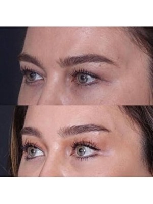 Akolife Botoks Tokası Face Lift ( Kahve) Eyebrow Lift Cat Eye