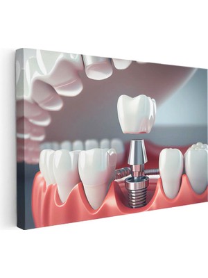 Tablofest Yatay Kanvas Tablo Implant Vidası Yerleştirme Kesiti Diş Hekimi Tablosu Ev Ofis Duvar Dekoru