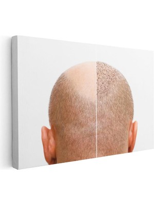 Tablofest Yatay Kanvas Tablo Saç Ekimi Öncesi Sonrası Saç Ekim Uzmanı Tablosu Ev Ofis Duvar Dekoru