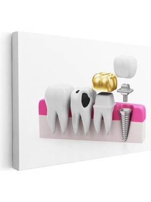Tablofest Yatay Kanvas Tablo Altın Kaplama ve Implant Diş Diş Hekimi Tablosu Ev Ofis Duvar Dekoru