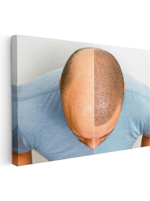 Tablofest Yatay Kanvas Tablo Tepe Bölgesi Saçlanma Farkı Saç Ekim Uzmanı Tablosu Ev Ofis Duvar Dekoru