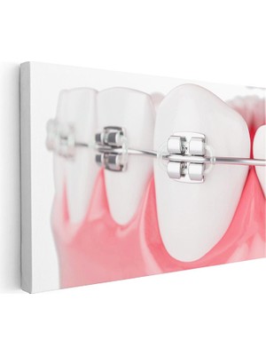 Tablofest Yatay Kanvas Tablo Diş Üzerinde Ortodontik Braketler Diş Hekimi Tablosu Ev Ofis Duvar Dekoru