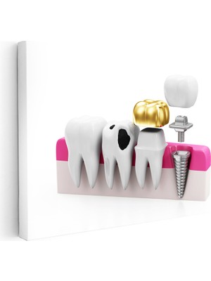 Kanvas Tablo Altın Kaplama ve Implant Diş Diş Hekimi Tablosu Ev Ofis Duvar Dekoru