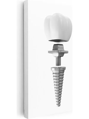 Kanvas Tablo Dental Implant Parçaları Diş Hekimi Tablosu Ev Ofis Duvar Dekoru