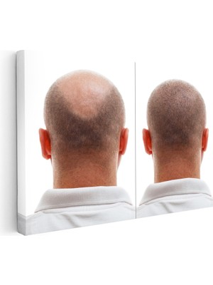 Kanvas Tablo Ense Bölgesi Saç Yenilenmesi Saç Ekim Uzmanı Tablosu Ev Ofis Duvar Dekoru