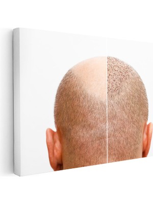 Kanvas Tablo Saç Ekimi Öncesi Sonrası Saç Ekim Uzmanı Tablosu Ev Ofis Duvar Dekoru
