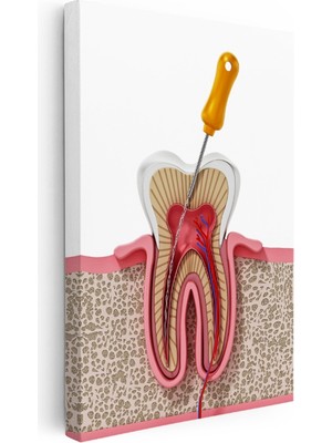 Kanvas Tablo Diş Kökü Kanal Tedavisi Kesiti Diş Hekimi Tablosu Ev Ofis Duvar Dekoru