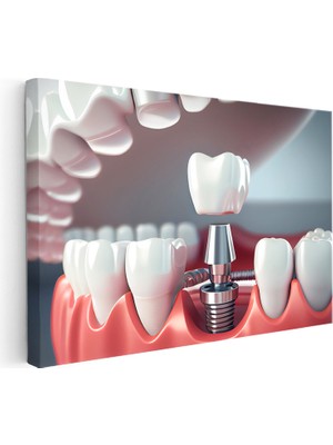 Kanvas Tablo Implant Vidası Yerleştirme Kesiti Diş Hekimi Tablosu Ev Ofis Duvar Dekoru