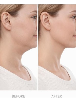 Lenf Drenaj Fırçası Yüz ve Vücut Için Kuru Masaj Fırçası Selülit Azaltıcı Cilt Arındırıcı Lenfatik Akış Destekleyici Ergonomik Saplı Şekillendirici Masaj Aracı (Ikili)