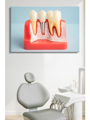 Şehber Yatay Kanvas Tablo Tekli Ağız Diş Sağlığı Dişçi Poliklinik Hastane Dental Implant Simülasyonu 2949