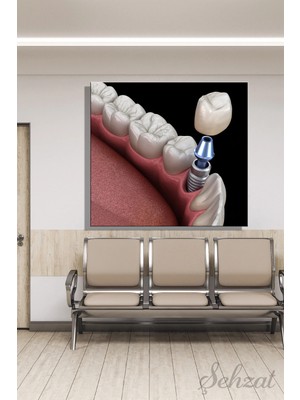 Şehzat Kare Kanvas Duvar Tablosu Tekli  Ağız Diş Sağlığı Dişçi Klinik Implant Diş Çürümesi Vida 3D