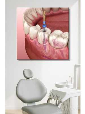 Şehber Endodontik Kanal Tedavisi Kare Kanvas Tablo Tekli Ağız Diş Sağlığı Dişçi Poliklinik Hastane 3479