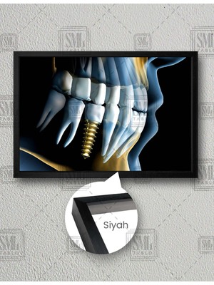 SML Tablo Diş Hekimi Ofisi Gold Implant Ağız ve Diş Sağlığı Yatay Çerçeveli Kanvas Tablo