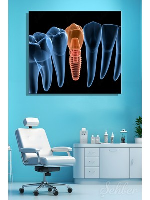 Şehber Küçük Azı (Premolar) Dental Implant Tıbbi 3D Illüstrasyon Yatay Kanvas Tablo Tekli 3652