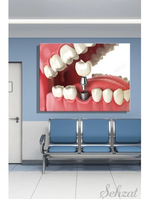 Şehzat Yatay Kanvas Duvar Tablosu Tekli  Ağız Diş Sağlığı Dişçi Implant Kaplama Vidalı Diş Protez Dental