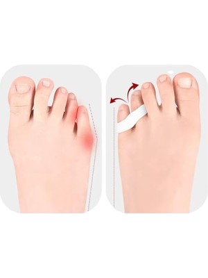 Kazan Hobi Ayak Serçe Parmak Duruş Düzeltici, Sürtünme ve Yana Batmayı Engelleyici, Silikon Bunyon Aparat, Yastıklama, Unisex, Yan Parmağa Ğeçmeli/geçmesiz Seçenekli (1 Çift) (Yan Parmak Geçmeli)