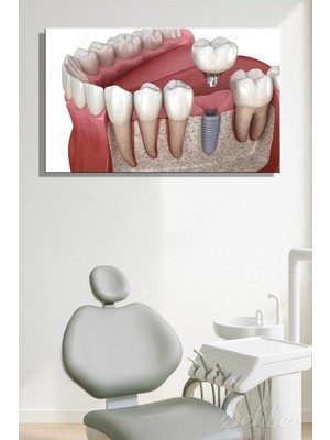 Şehzat Design Titanyumdan Üretilen Yapay Bir Diş Kökü Olan Dental Implant Sistemi Yatay Kanvas Tablo 3509
