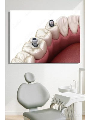 Şehzat Design Dental Implant Sistemi Sabitleme Vidalarını Gösteren 3D Tıbbi Illüstrasyon Yatay Kanvas Tablo 4442