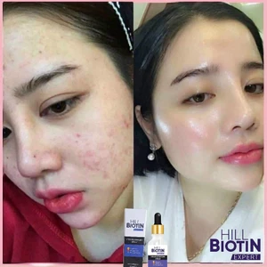 Hill Biotin Expert C Vitamini & aydınlatıcısivilce karşıtıyüzSerum 30ml