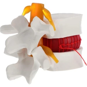 Disk Hernisi Fıtık Simülatörü - Fıtık Maketi