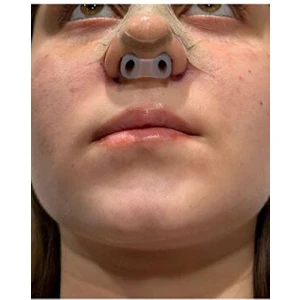 footlıne foot healthly Burun Deliği Şekillendirici(1)(7)Nostril Retainer