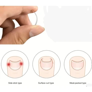 Baş Parmak Tırnak Batmasını Engelleyen Metal Aparat - Nrd 603