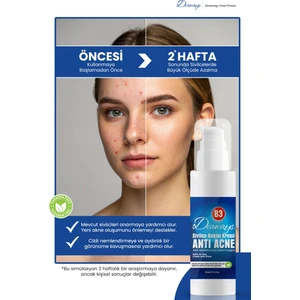 Aydınlatıcı Sîvîlce ve Âkne Karşıtı,sivilceye ve Akneye Karşı Siyah nokta Önleyici Cilt Bakım Yenileyici Kremi