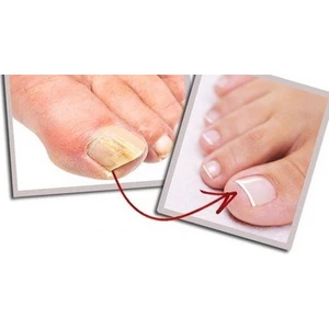 Tırnak Mantar Serumu