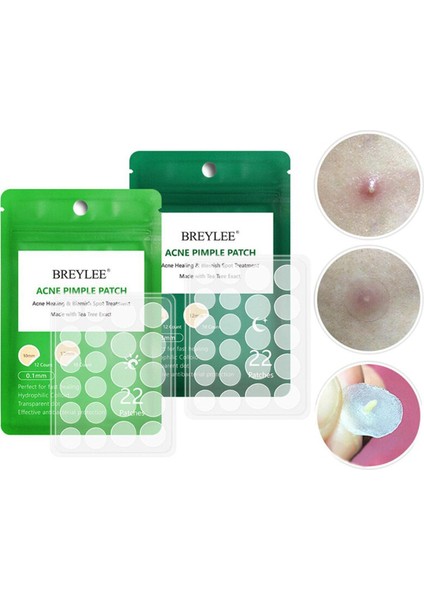 Akne Sivilce Yama Akne Tedavisi Çıkartmalar Sivilce Sökücü Aracı Leke Nokta Cilt Bakımı Yüz Su Geçirmez Gündüz Gece Kullanımı (Yurt Dışından)