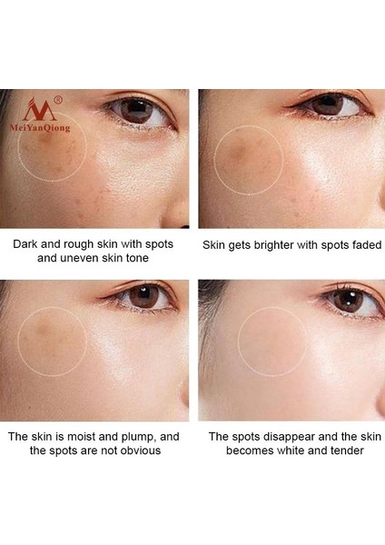 1 【happytree】 Güçlü Beyazlatıcı Çil Kremi Akne Noktalarını Kaldır Melanin Koyu Noktalar Yüz Germe Sıkılaştırıcı Yüz Cilt Bakımı Güzellik Esasları (Yurt Dışından) fırsatları