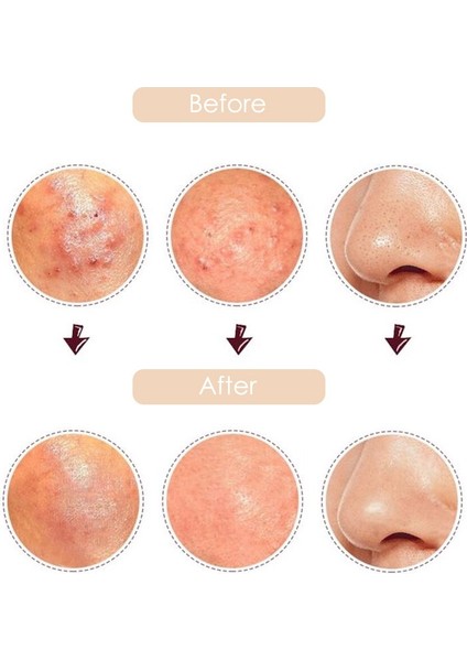 Adet/takım Akne Siyah Nokta Remover Siyah Noktalar Gözenek Temizleyici Iğneler Araçları Yüz Komedon Akne Sivilce Leke Çıkarıcı Sökücü (Yurt Dışından) modelleri