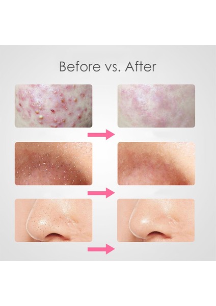 3 Adet/grup Akne Iğne Cımbız Siyah Nokta Leke Sivilce Kaldırma Sivri Viraj Gib Kafa Yüz Bakımı Araçları Comedone Akne Çıkarıcı (Yurt Dışından) fırsatları