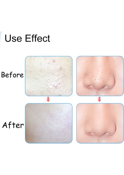 Siyah Nokta Sivilce Temizleme Sivri Bükme Gib Başkanı Komedon Çıkarıcı Aracı - Gümüş (Yurt Dışından) indirimleri