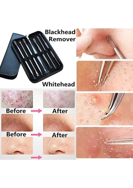 9 Adet Paslanmaz Akne Iğnesi Siyah Nokta ve Sivilce Sökücü Yüz Bakımı Komedon Çıkarıcı Kafa Sökücü Aracı Setleri Nokta Temiz SIYAH9PCS Opp（9pcs Opp） (Yurt Dışından) modelleri