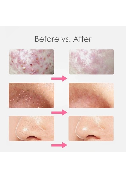 7 Adet Komedon Yüz Cilt Bakımı Aracı Iğneler Yüz Temizleyici (Yurt Dışından) modelleri