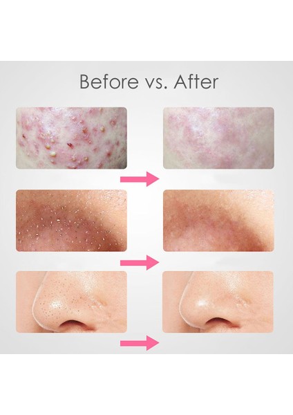 Yüz Cilt Bakımı Iğnesi Yüz Temizleyici(Yurt Dışından) fırsatları