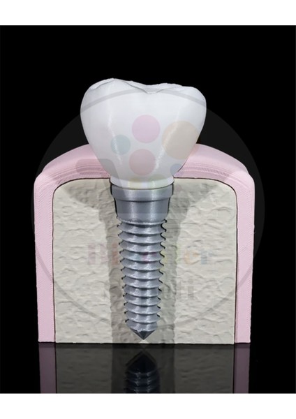 Diş Implantı Dekoratif Figür - 16 cm