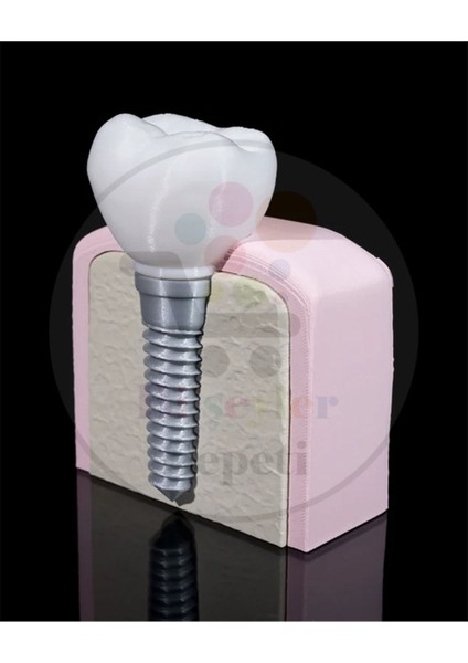 Diş Implantı Dekoratif Figür - 16 cm fiyatları