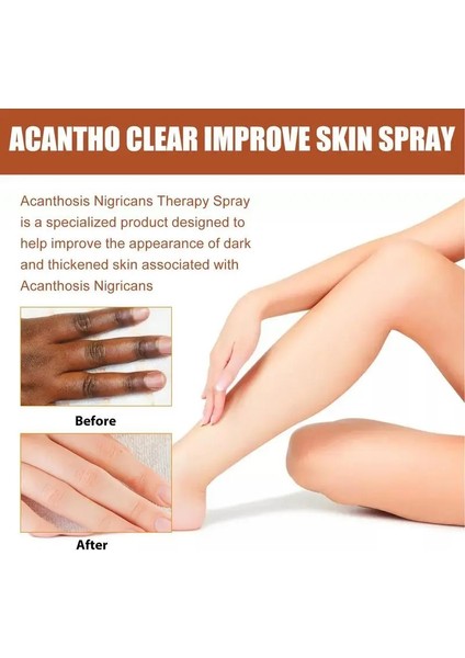 30 ml Tarzı Koyu Nokta Giderici 30ML Acantho Şeffaf Sprey Beyazlatıcı Koyu Cilt Koltuk Altı Aydınlatma Mahrem Bölgeler Koltuk Altı Diz Vücut Cilt Bakımı (Yurt Dışından) fiyatları
