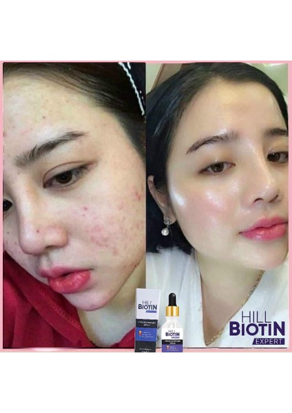 C Vitamini & aydınlatıcısivilce karşıtıyüzSerum 30ml