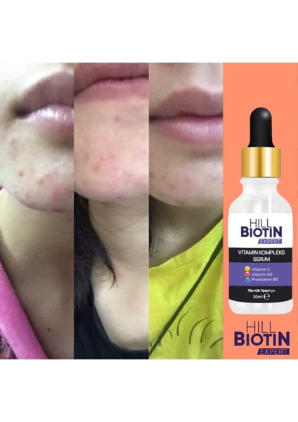 C Vitamini & aydınlatıcısivilce karşıtıyüzSerum 30ml